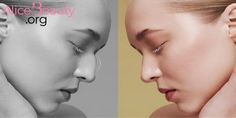 Cần tuân thủ hướng dẫn y khoa ngay sau phẫu thuật nâng mũi