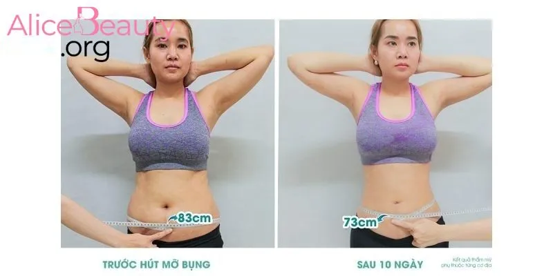 Bóc mỡ
