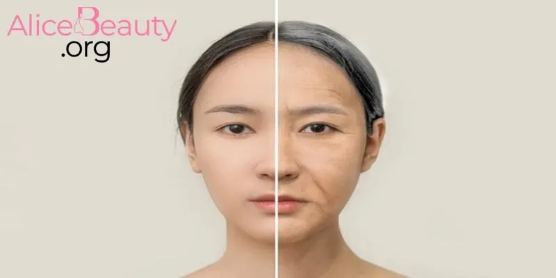 Botox xoá nếp nhăn tại Alice Beauty