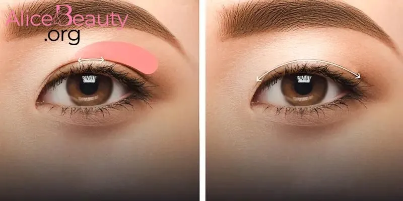 Cẩm nang cho nàng sau khi nhấn mí