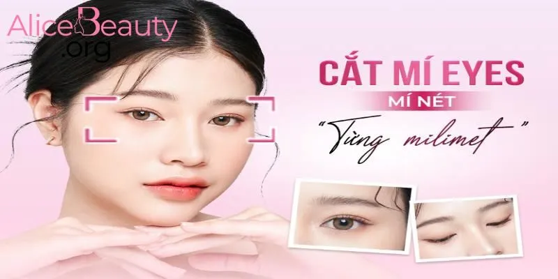 Cắt mí