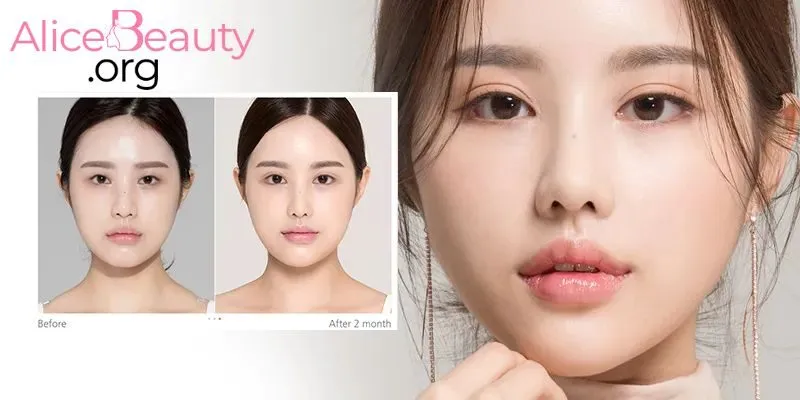 Cắt mí là kỹ thuật thẩm mỹ nhằm tạo ra nếp mí rõ ràng giúp đôi mắt trẻ trung hơn