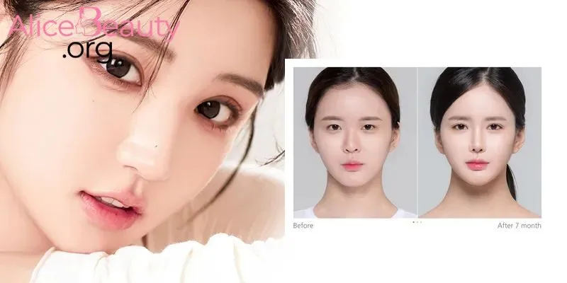 Cắt mí khiến đôi mắt trông to hơn, có chiều sâu và thần thái cuốn hút