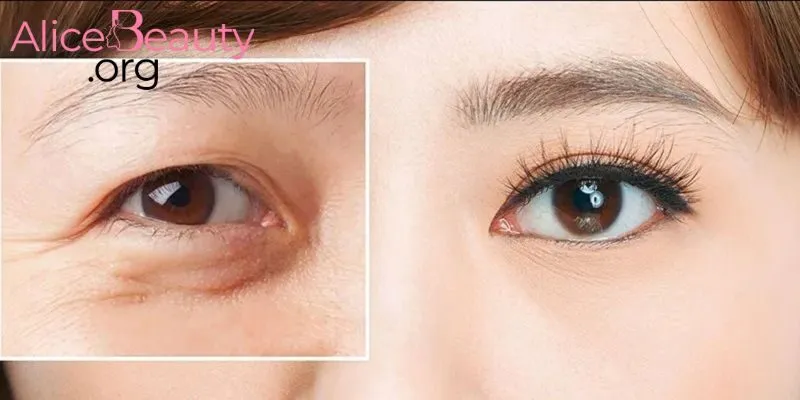 Khách hàng cần tuân thủ những lưu ý cần thiết sau khi cắt mí