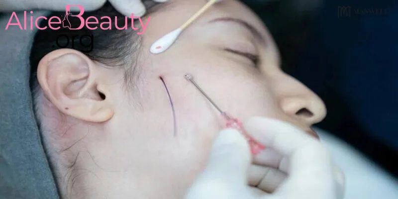 Cấy chỉ Collagen là sử dụng những sợi chỉ collagen đặc biệt cấy vào lớp hạ bì của da để nâng cơ, trẻ hóa da