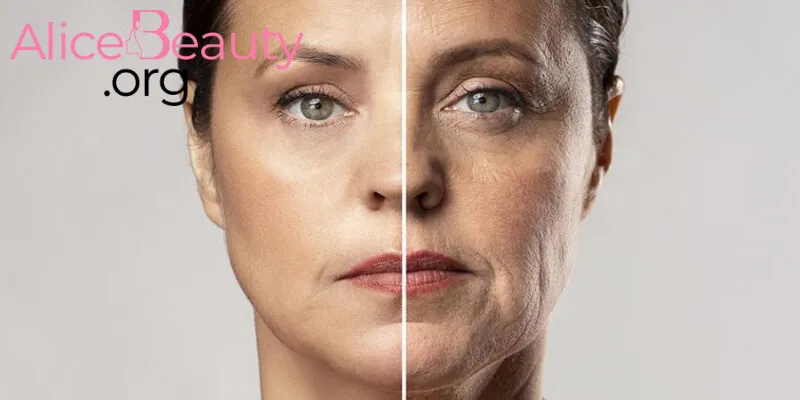 Sau khoảng 6 – 12 tháng, chỉ collagen sẽ phân hủy, được cơ thể hấp thụ hoàn toàn, duy trì hiệu quả trẻ hóa da