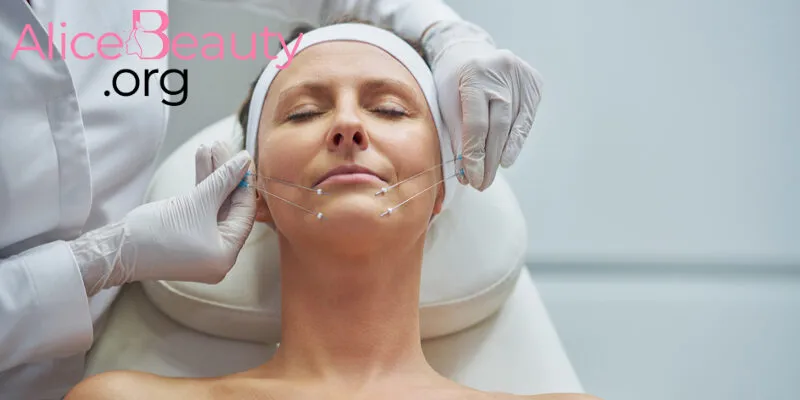 Phương pháp cấy chỉ collagen đem lại nhiều hiệu quả nhưng không để lại sẹo hay vết thâm, không cần nghỉ dưỡng sau thực hiện