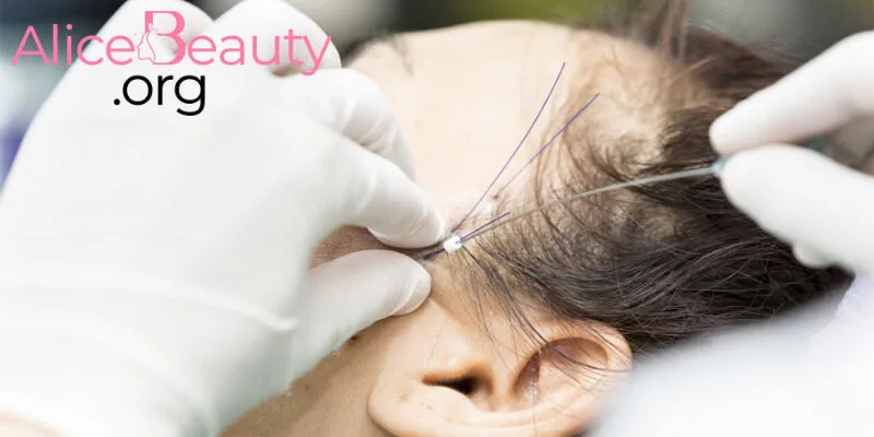 Bất kỳ ai muốn trẻ hóa, nâng cơ, ngăn ngừa lão hóa da đều có thể chọn phương pháp căng chỉ Collagen 
