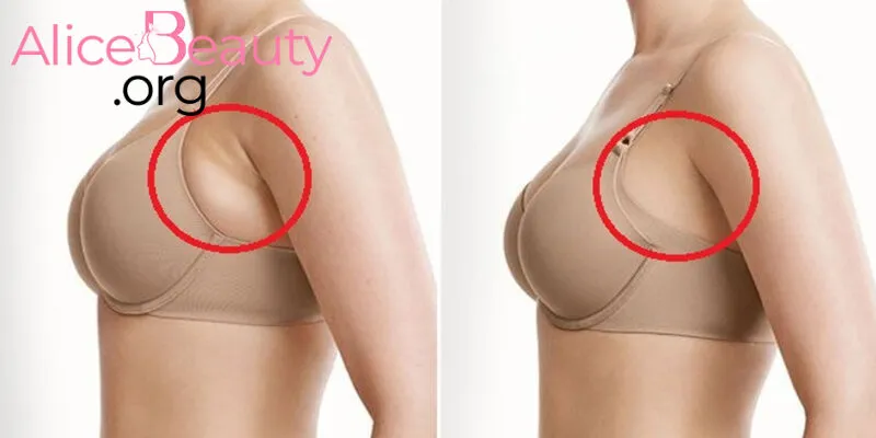 Dịch vụ săn chắc  vùng da nách cũng hỗ trợ giảm tiết mồ hôi dưới cánh tay hiệu quả