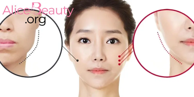 Tiêm Botox giúp làm căng cơ, săn chắc vùng da cằm, giúp gương mặt thon gọn hơn