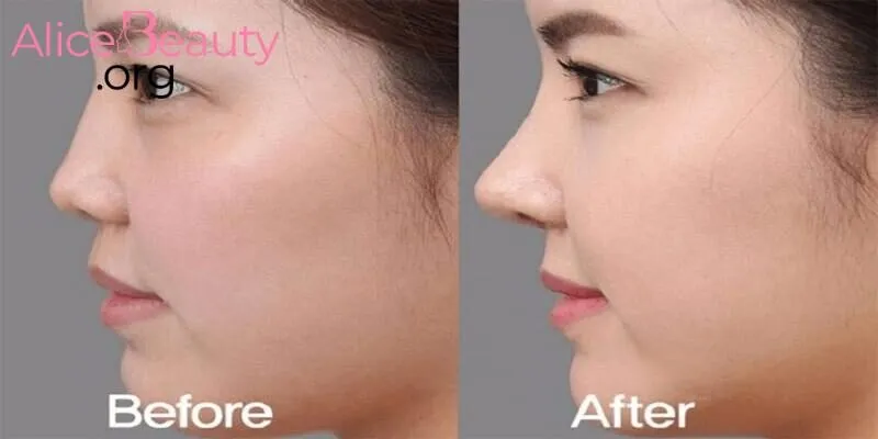 Feedback khách hàng sau khi sử dụng filler tại Alice Beauty