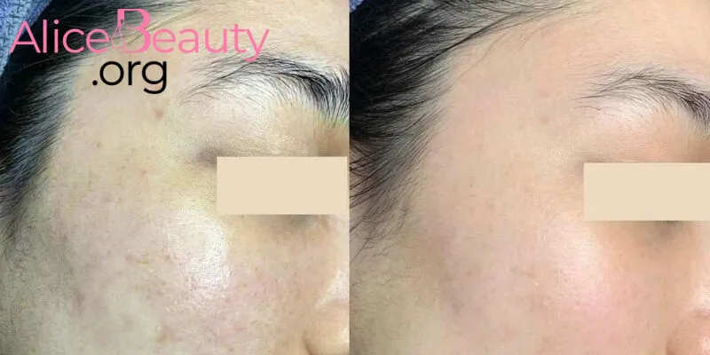 Meso (Exo Some, Exocode) là hai liệu pháp hiệu quả để cải thiện cấu trúc da, làm trẻ hóa, giảm thâm nám cho da