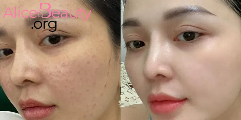 Meso (Exo Some, Exocode) đều giúp cải thiện kết cấu da, giúp da tươi trẻ, sáng mịn hơn