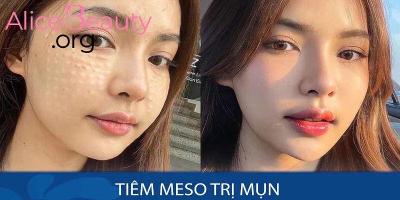 Liệu trình điều trị với Meso (Exo Some, Exocode) cần kéo dài từ 6 tháng đến 1 năm để đạt được hiệu quả tốt nhất