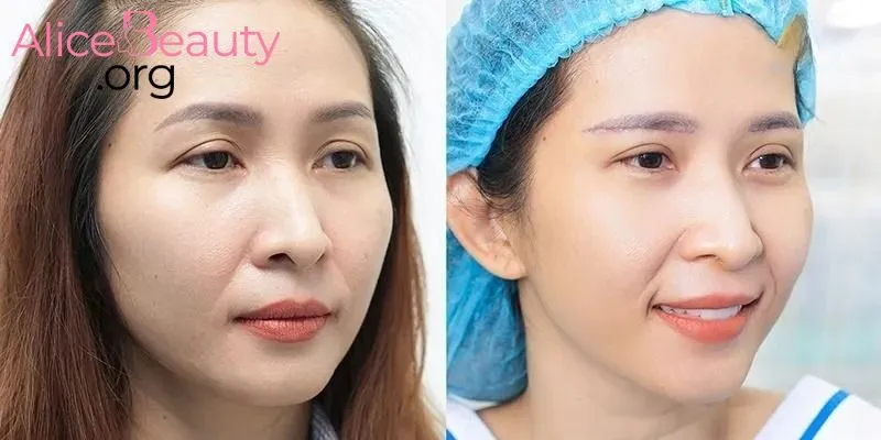 Nâng cung là kỹ thuật thẩm mỹ tiên tiến nhằm cải thiện độ cao và hình dáng của cung mày