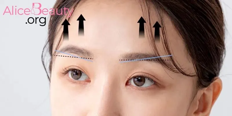 Nâng cung giúp xóa bỏ nếp nhăn mang lại diện mạo tươi sáng, trẻ trung