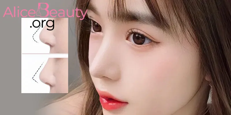 Phẫu thuật nâng mũi sẽ can thiệp vào cấu trúc mũi để nó hài hòa với khuôn mặt hơn