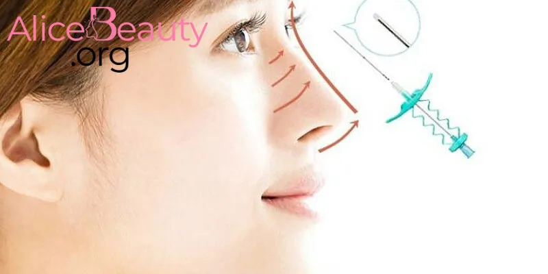 Nâng mũi bằng chỉ sinh học cũng là giải pháp giúp bạn sở hữu chiếc mũi đẹp hơn, ít xâm lấn, nhanh chóng