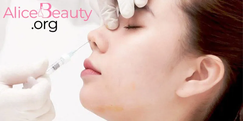 Phẫu thuật sửa mũi với sụn tổng hợp hay tự thân khá đơn giản và nhanh chóng