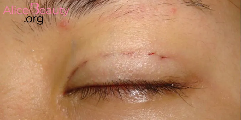 Hãy chọn địa chỉ uy tín để thực hiện nhấn mí hiệu quả, an toàn