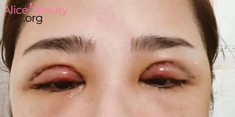 Sau nhấn mí, sưng và khó chịu là tình trạng phổ biến, mức độ sưng mỗi người rất khác nhau