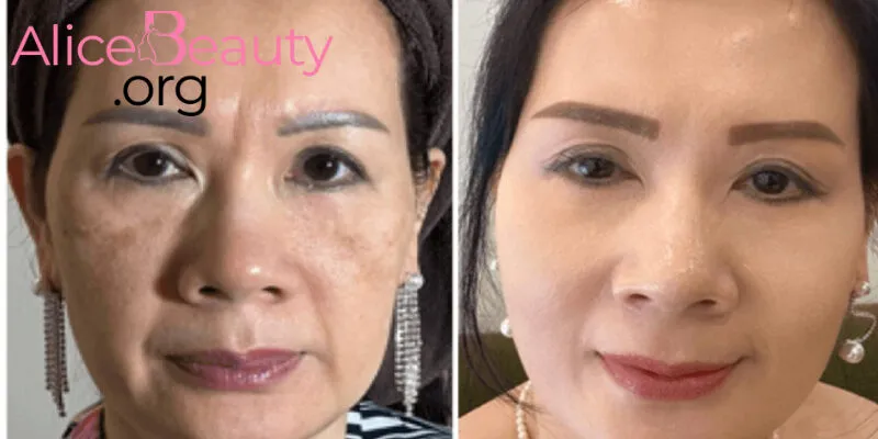 Sau khi tiêm BAP (Profhilo), làn da căng mịn hơn, giảm thiểu đáng kể dấu hiệu chảy xệ, nhăn nheo 