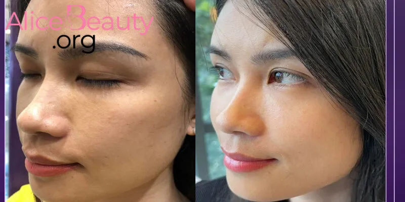 Tiêm BAP (Profhilo) còn giúp cải thiện tình trạng da xỉn màu, mang lại làn da sáng mịn hơn