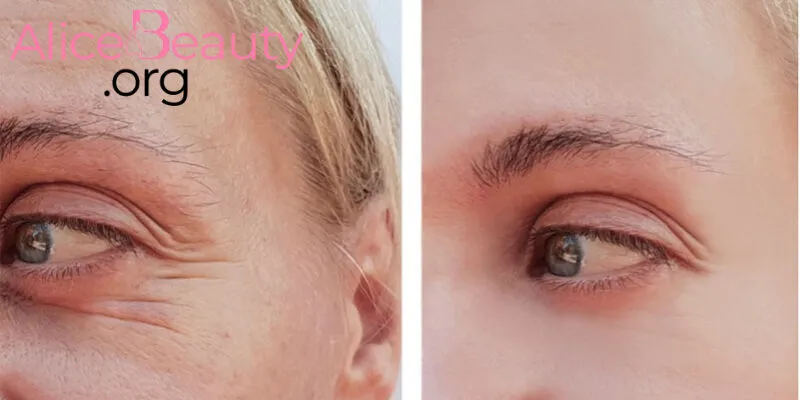 Với trường hợp nếp nhăn sâu sẽ cần can thiệp phẫu thuật để giảm nếp nhăn hiệu quả hơn