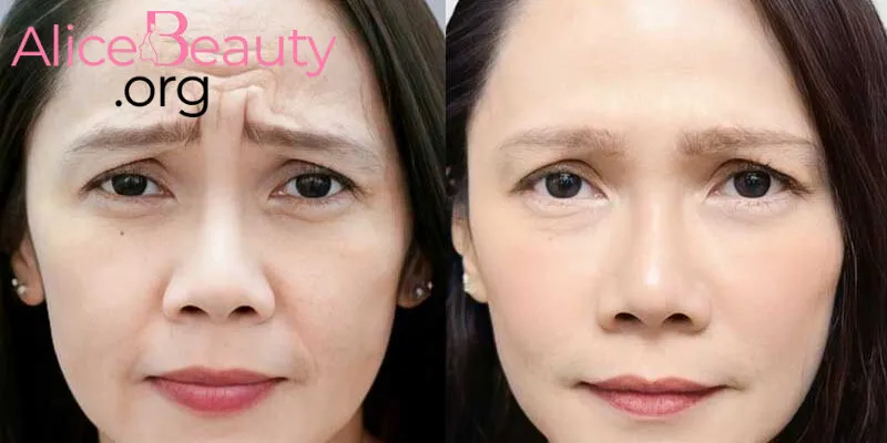 Hiểu rõ xóa nhăn là gì, các phương pháp phổ biến để có lựa chọn tối ưu để gìn giữ làn da tươi trẻ